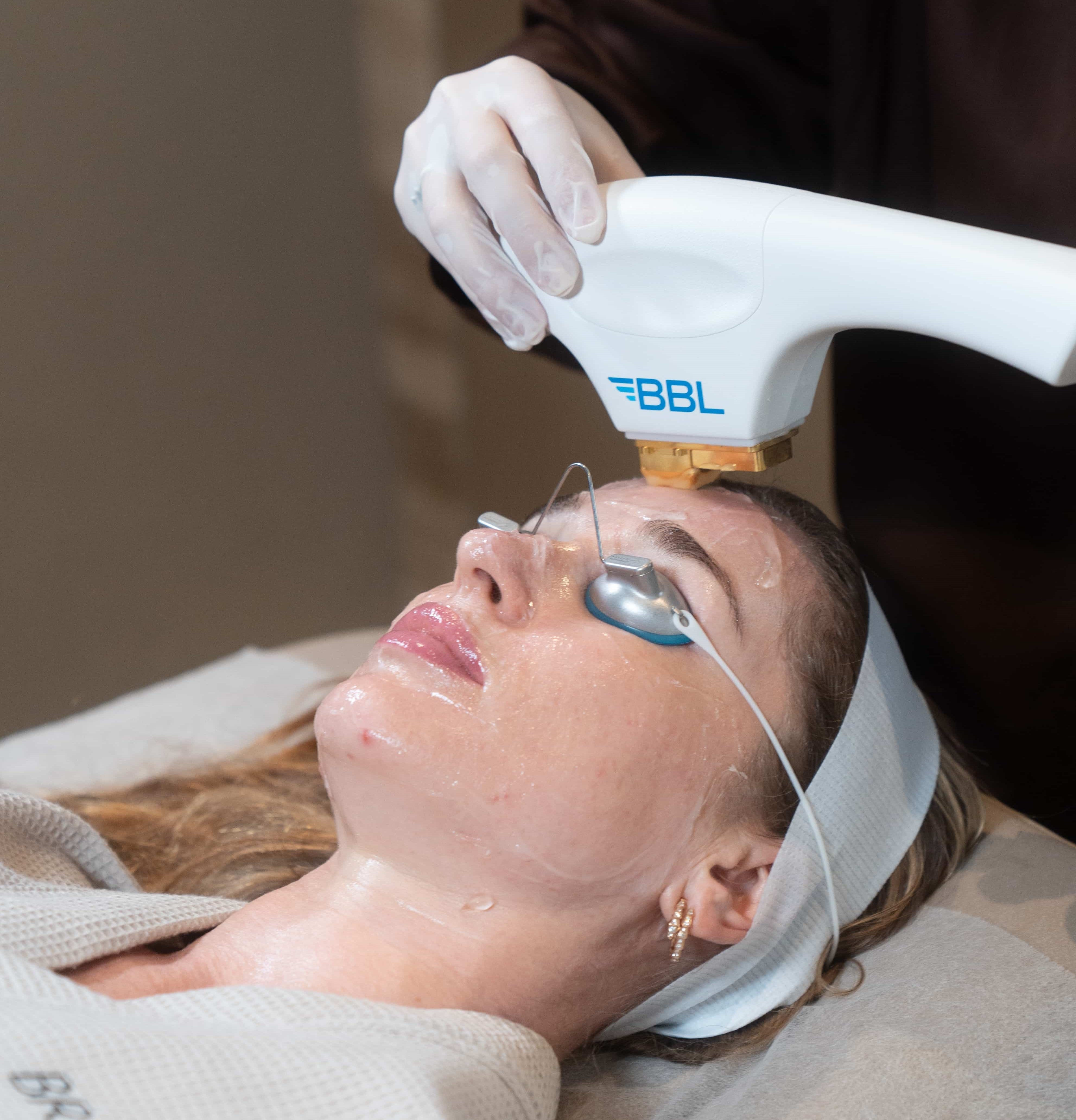 BBL laser treatment is being performed to rejuvenate skin, with BROWZ in Dubai offering advanced non-invasive skincare solutions.
