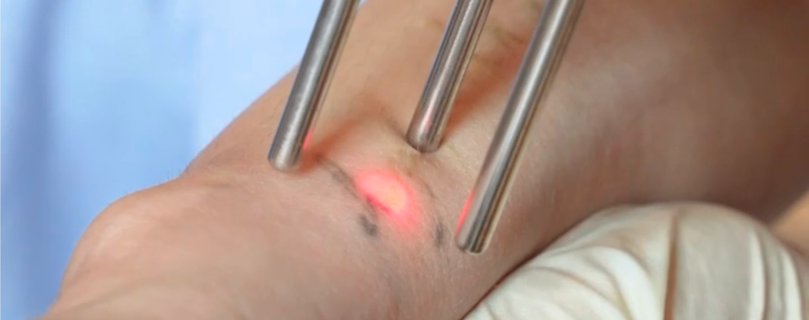 laser tatto removal process