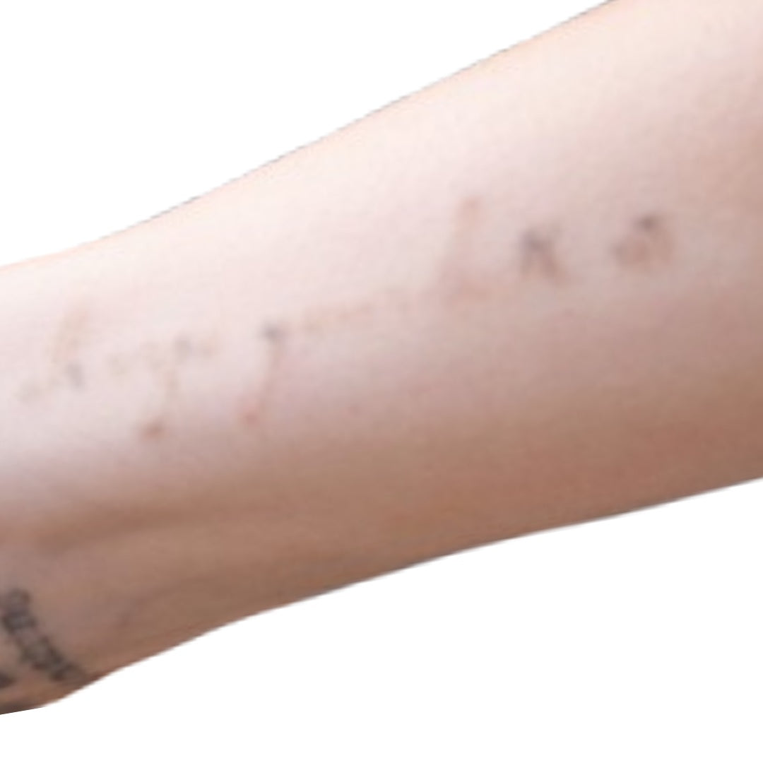 After the tattoo removal procedure