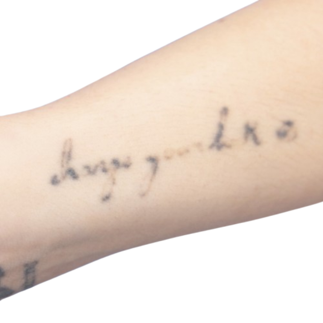 Before the tattoo removal procedure