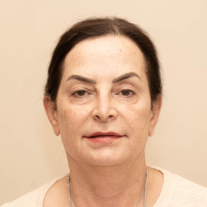 A woman’s face after Sofwave treatment, captured in the exact same angle, lighting, and framing, showing firmer, smoother, and more lifted-looking skin