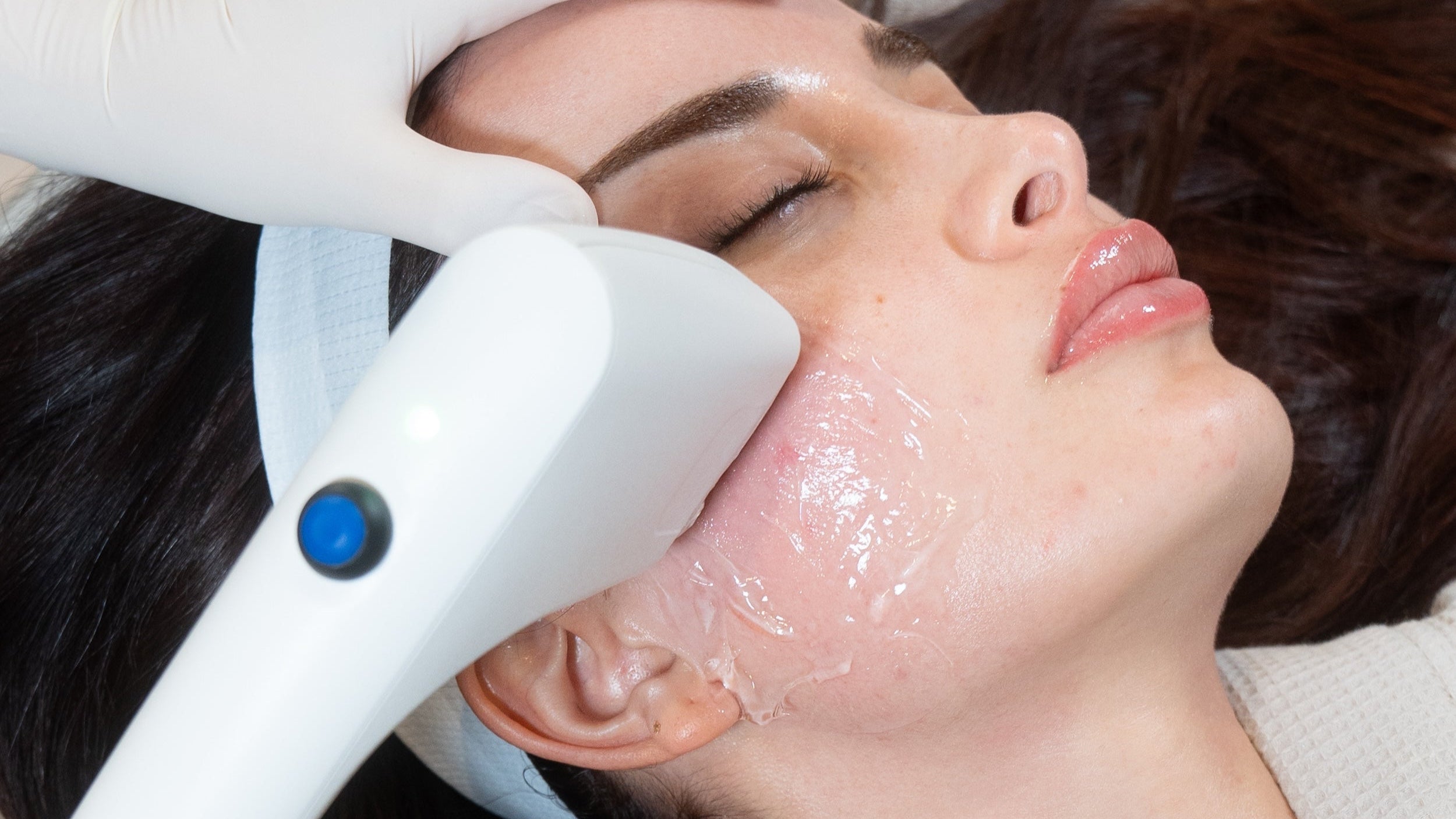 facial treatment for acne with BBL HERO