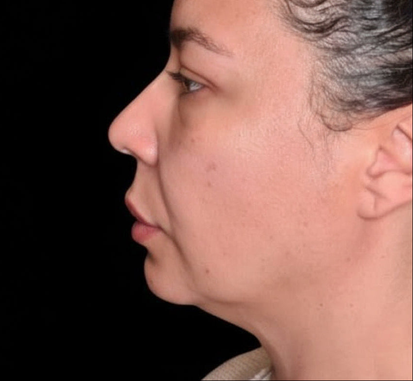 Side view look of a woman’s face with noticeable sagging and uneven texture before Profhilo Dubai treatment at BROWZ, UAE.