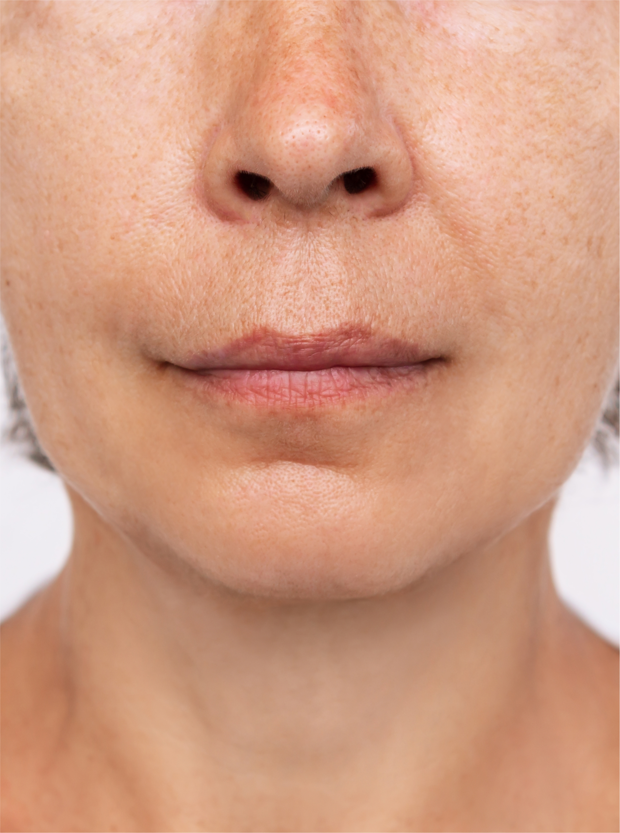 Visible improvement in skin texture with reduced wrinkles after treatment at BROWZ in Dubai, showing smoother, firmer skin.