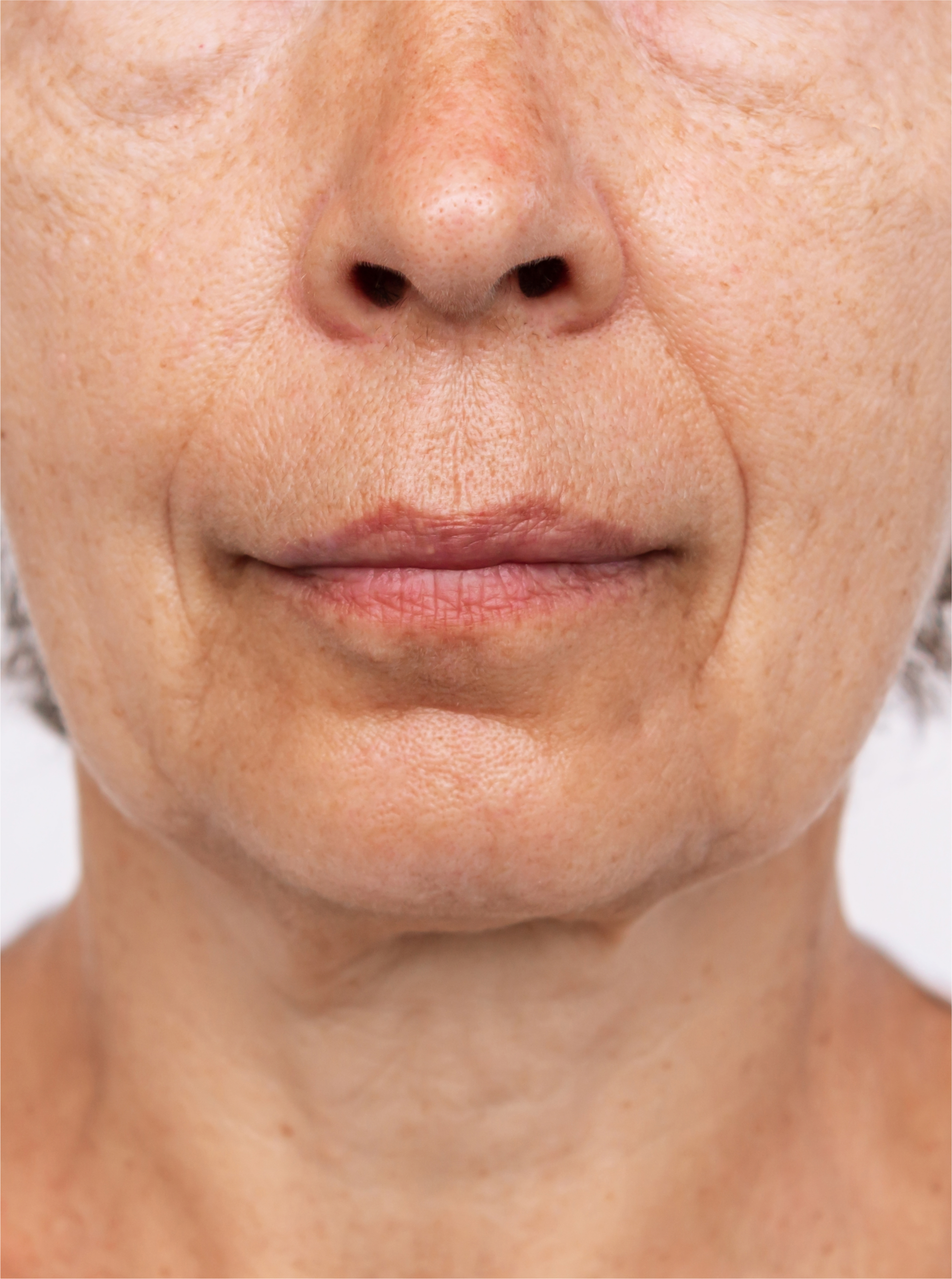 Lower face showing visible signs of ageing before treatment at BROWZ Dubai, highlighting wrinkles, fine lines, and sagging.