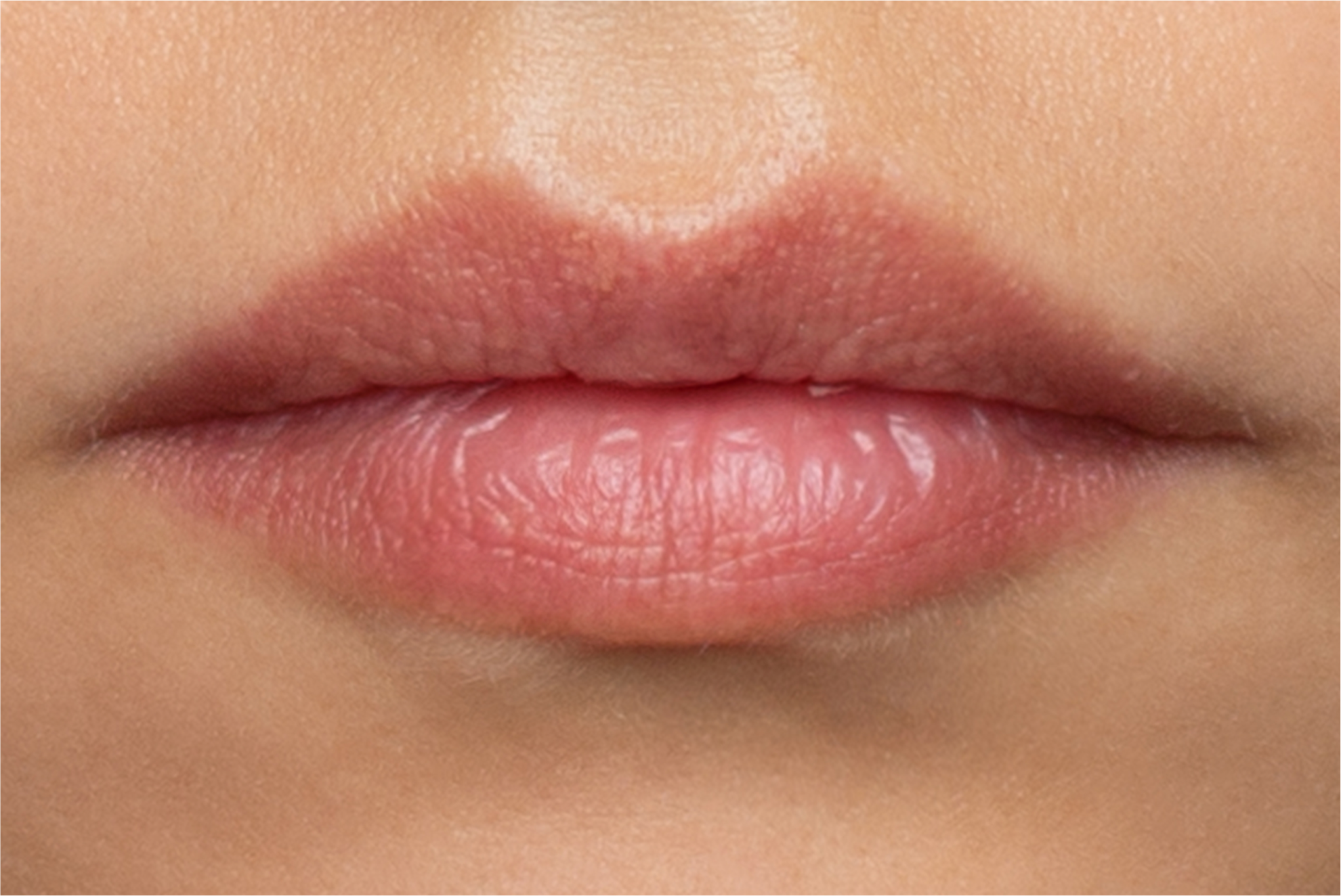 Lips after filler treatment are visibly fuller with improved shape and definition.