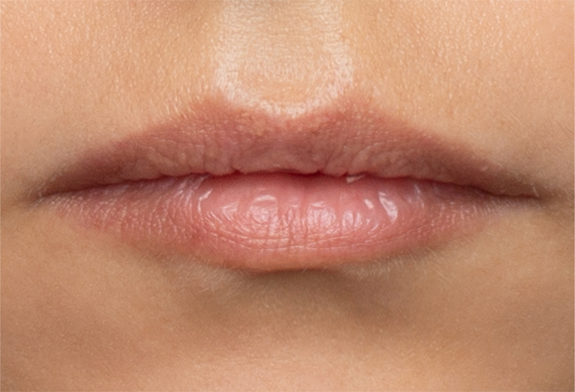 Natural thin lips before lip filler, showing their original shape.