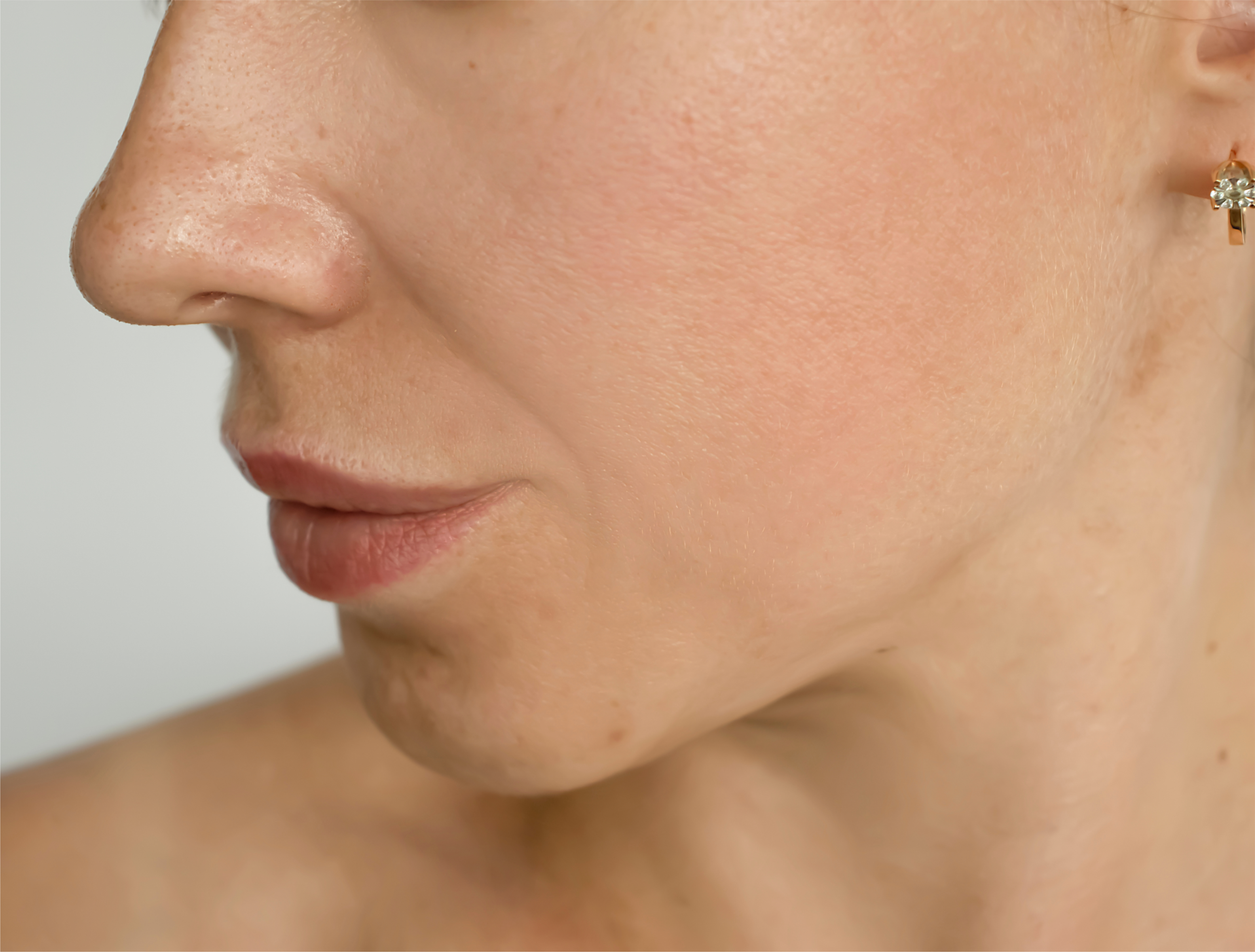A client receiving Profhilo treatment while a specialist prepares the injection area under clinical lighting.