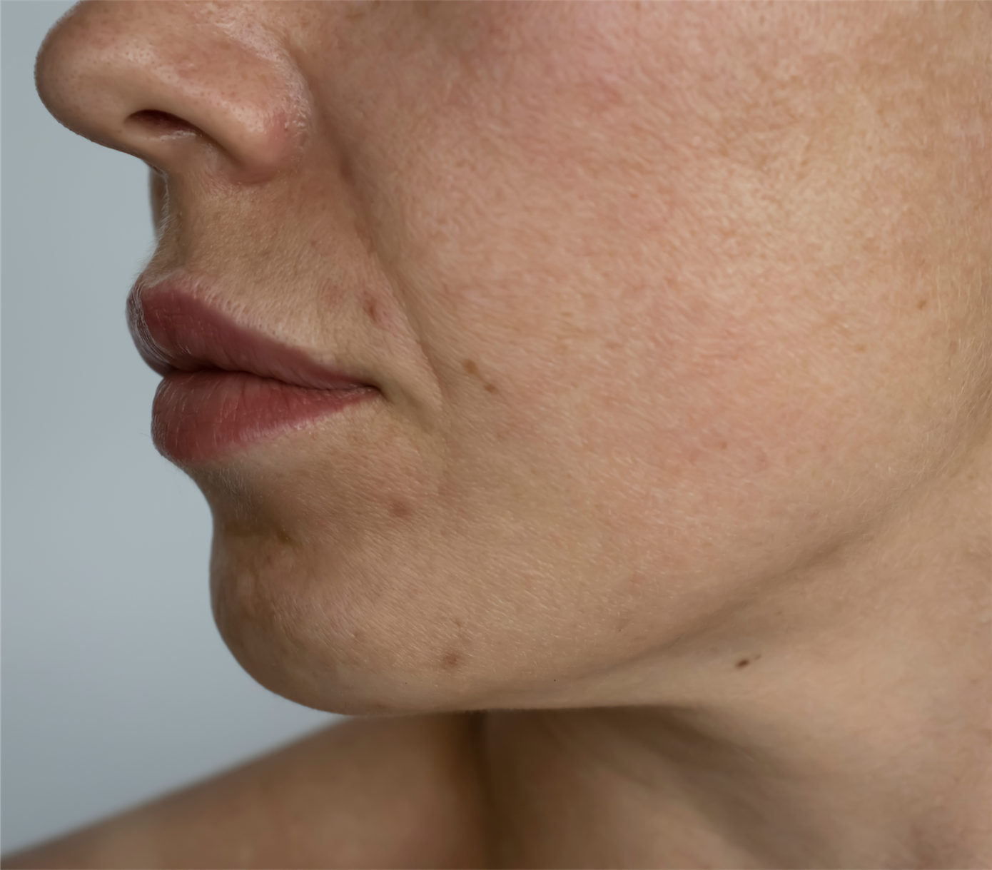 Side view of skin with visible fine lines and dull texture prior to Profhilo.