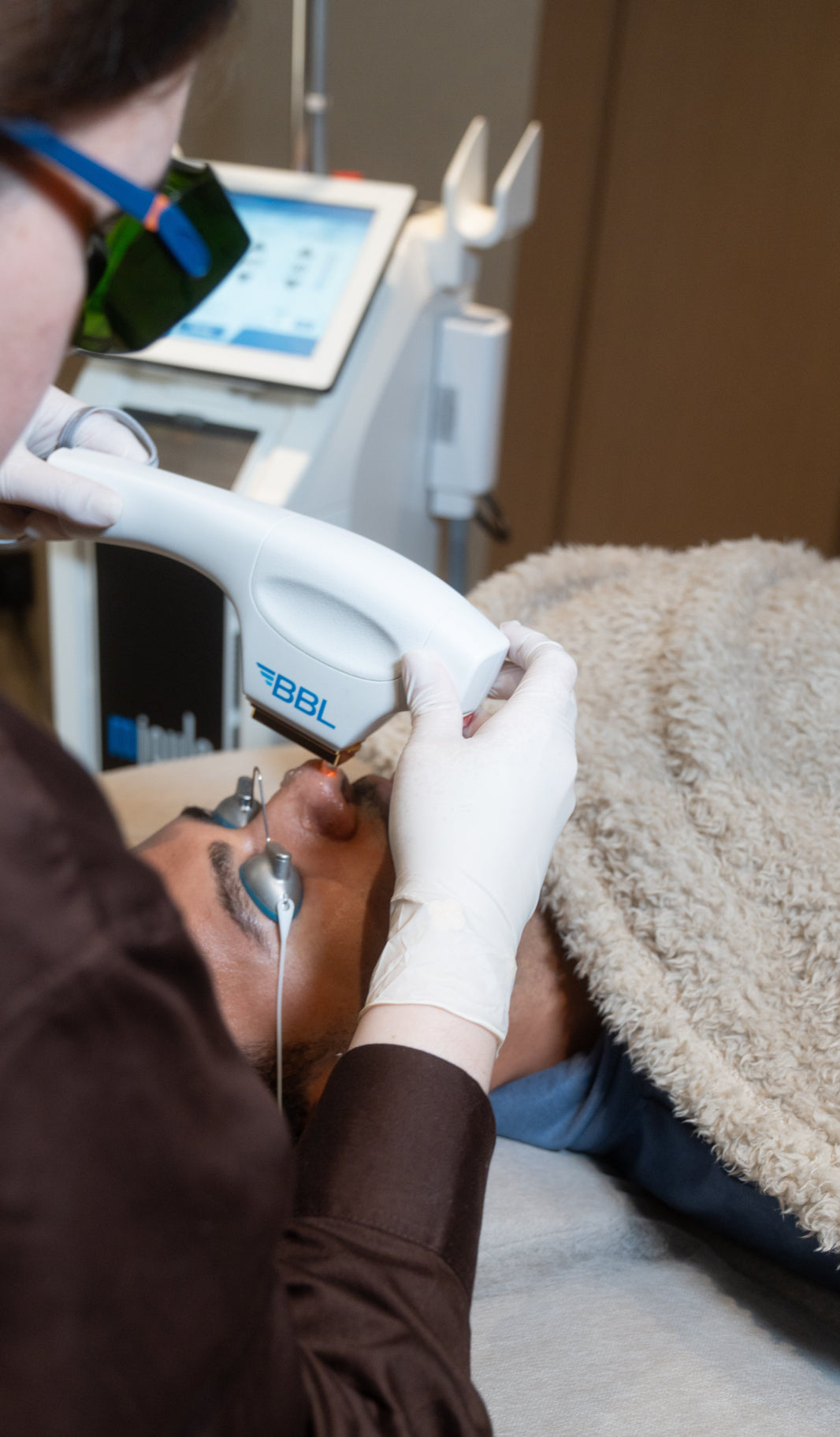 BBL laser treatment for acne and acne scars at BROWZ in Dubai, targeting skin clarity and smoothness for lasting results.