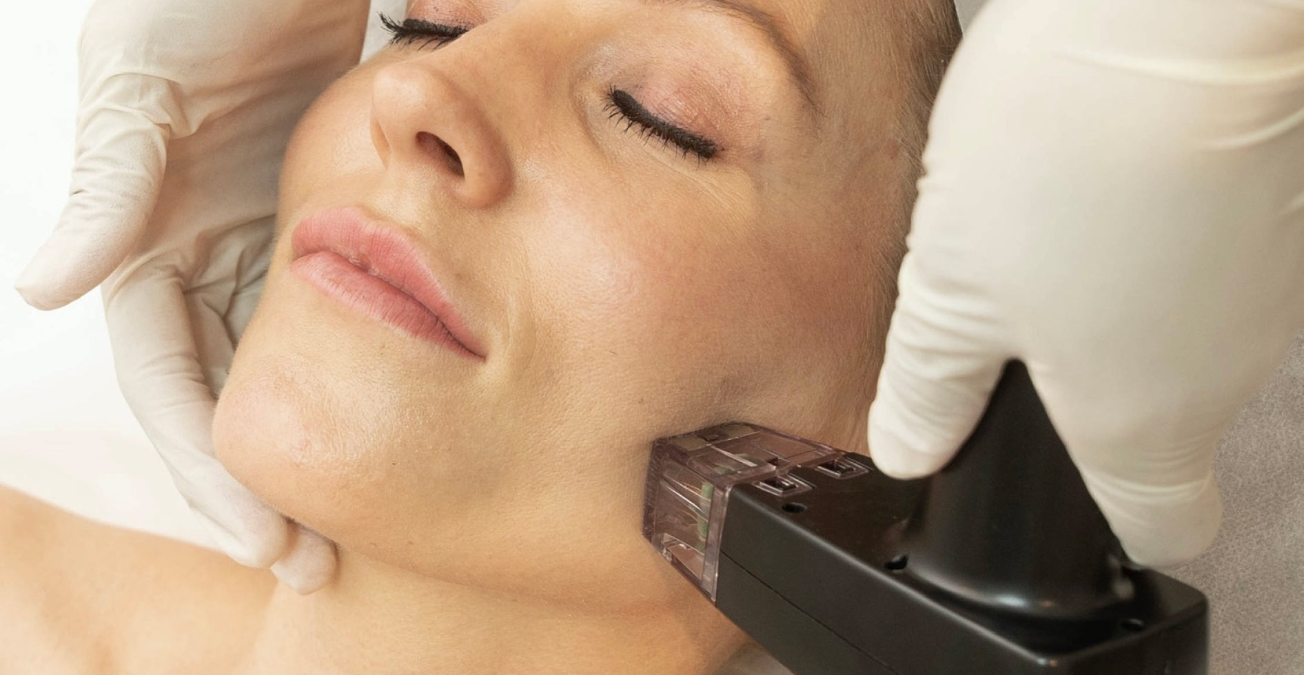 Microneedling procedure being performed on the lower face