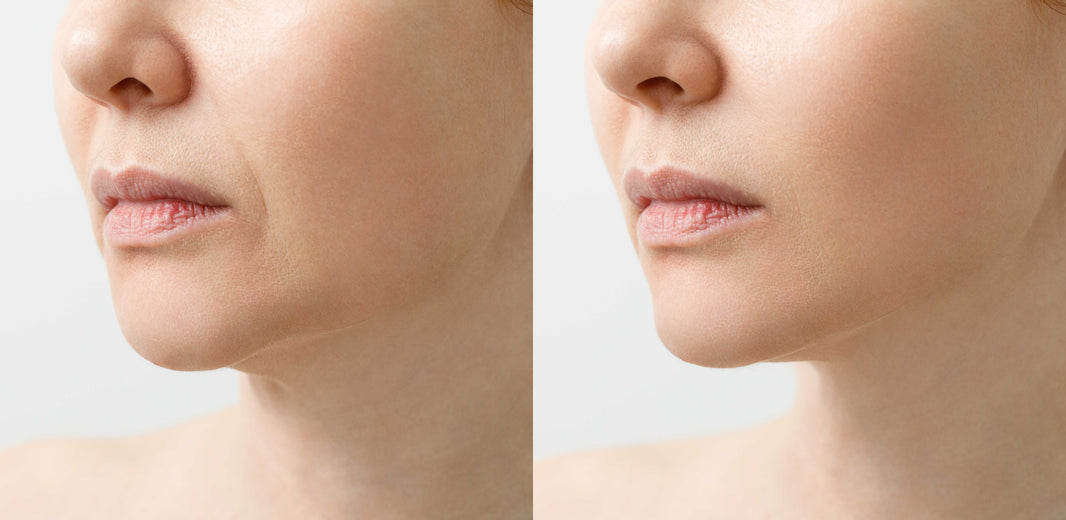 Profhilo treatment before and after