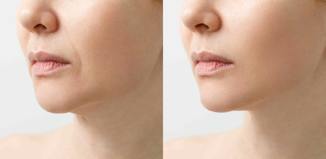 See the stunning Profhilo treatment before and after results at BROWZ in Dubai for smoother, firmer, youthful-looking skin.