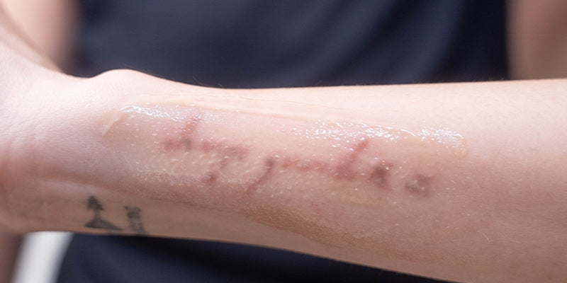 A client receiving laser tattoo removal treatment on the arm from a technician in a clinic