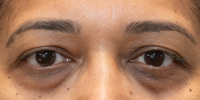 How to Get Rid of Dark Circles Under Eyes? Causes and Treatments