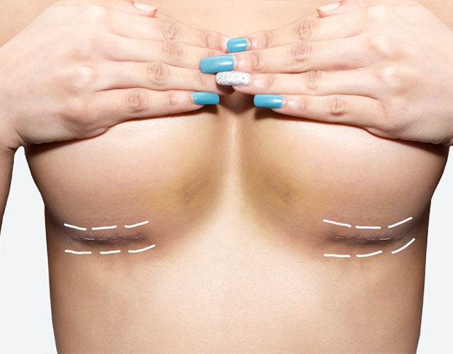 A woman's chest showing healing scars under the breasts, with dashed lines marking the incision sites from a breast lift procedure.
