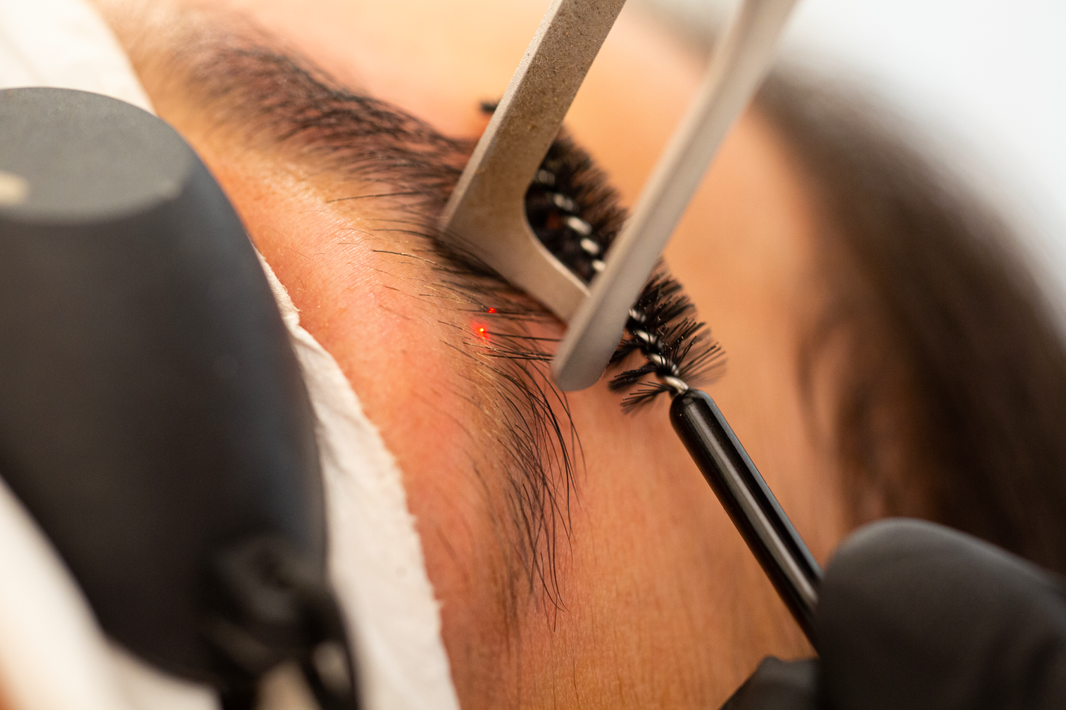 Correct Your Eyebrow Tattoo With Laser Tattoo Removal