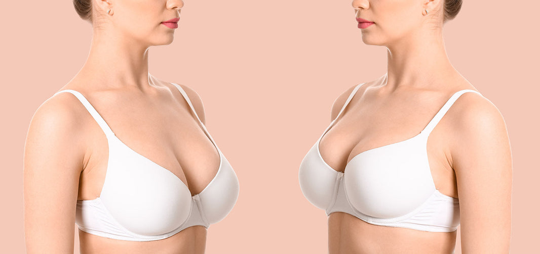 A close-up image of a woman's upper body with digital markings for a breast lift procedure.
