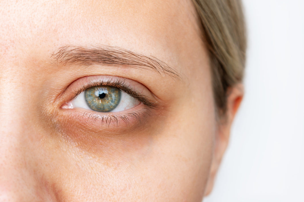 what causes dark circles under the eyes