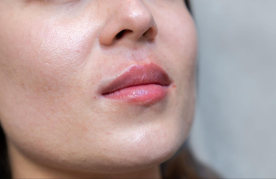 Results after a biofiller natural lip filler treatment in Dubai, UAE, showing soft, plump, and youthful-looking lips at BROWZ