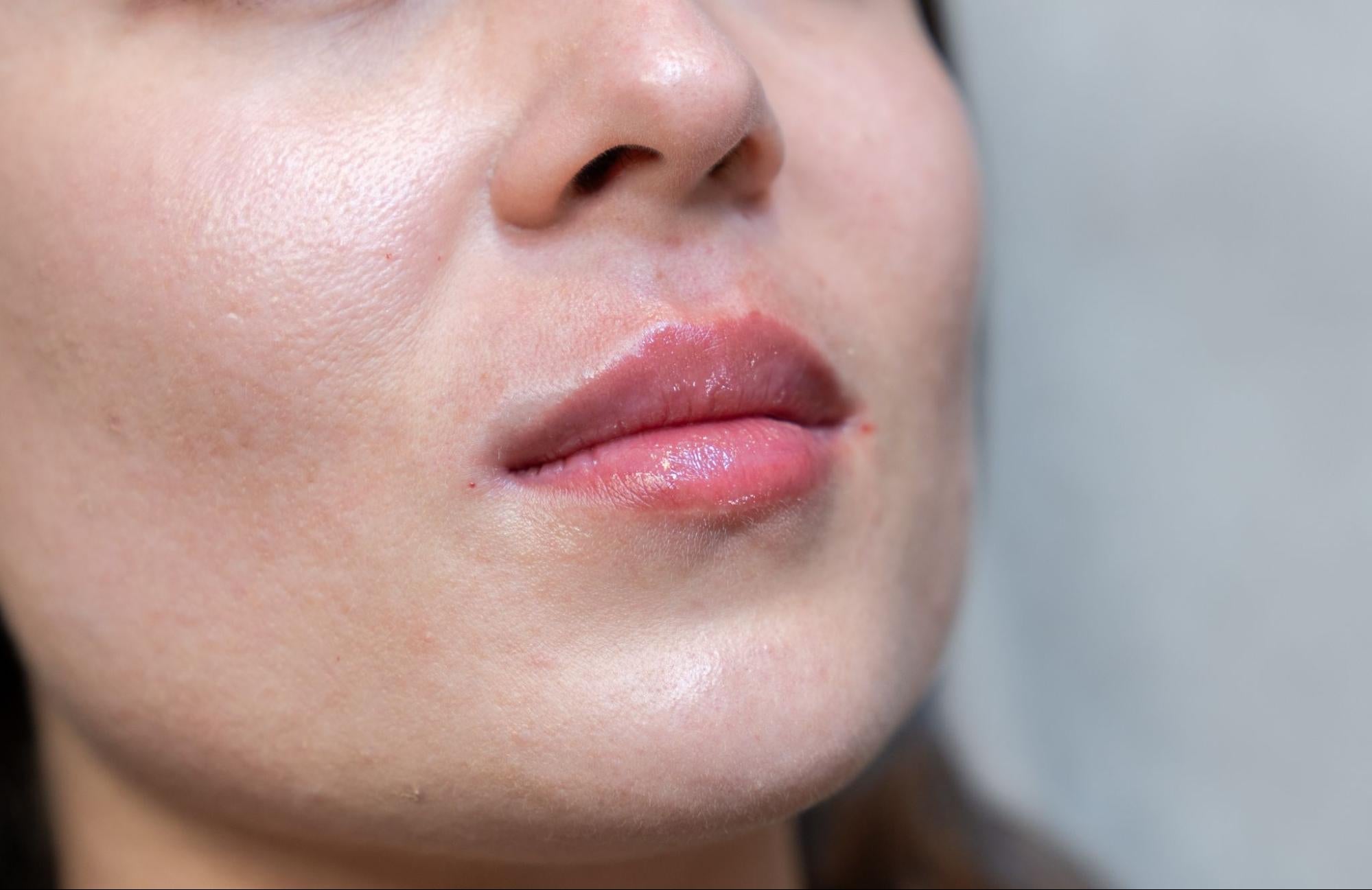 Results after a biofiller natural lip filler treatment in Dubai, UAE, showing soft, plump, and youthful-looking lips at BROWZ
