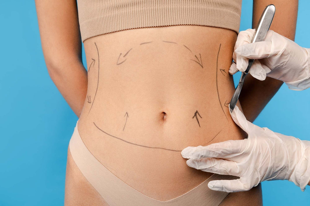 Liposuction surgery