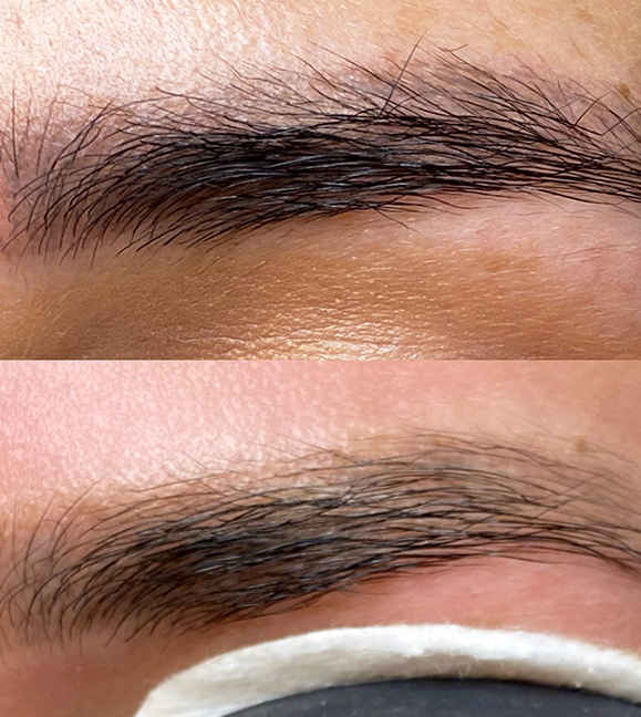 An In Depth Look Into Needle Brow Tattoo Removal