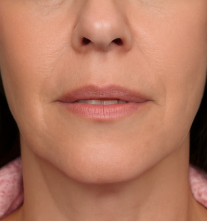 Close-up of a woman's lower face showing pronounced smile lines or nasolabial folds before Sculptra injections.