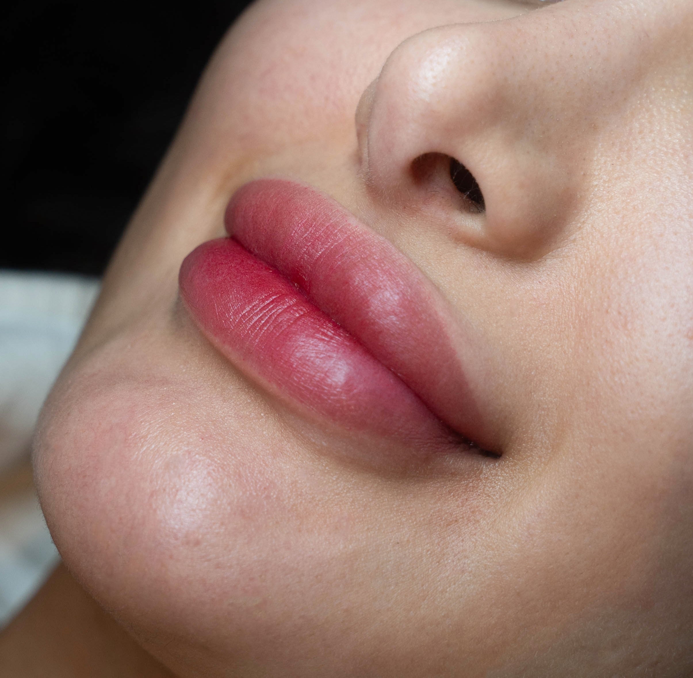 Lip filler being applied by a professional using precise technique on treatment day.