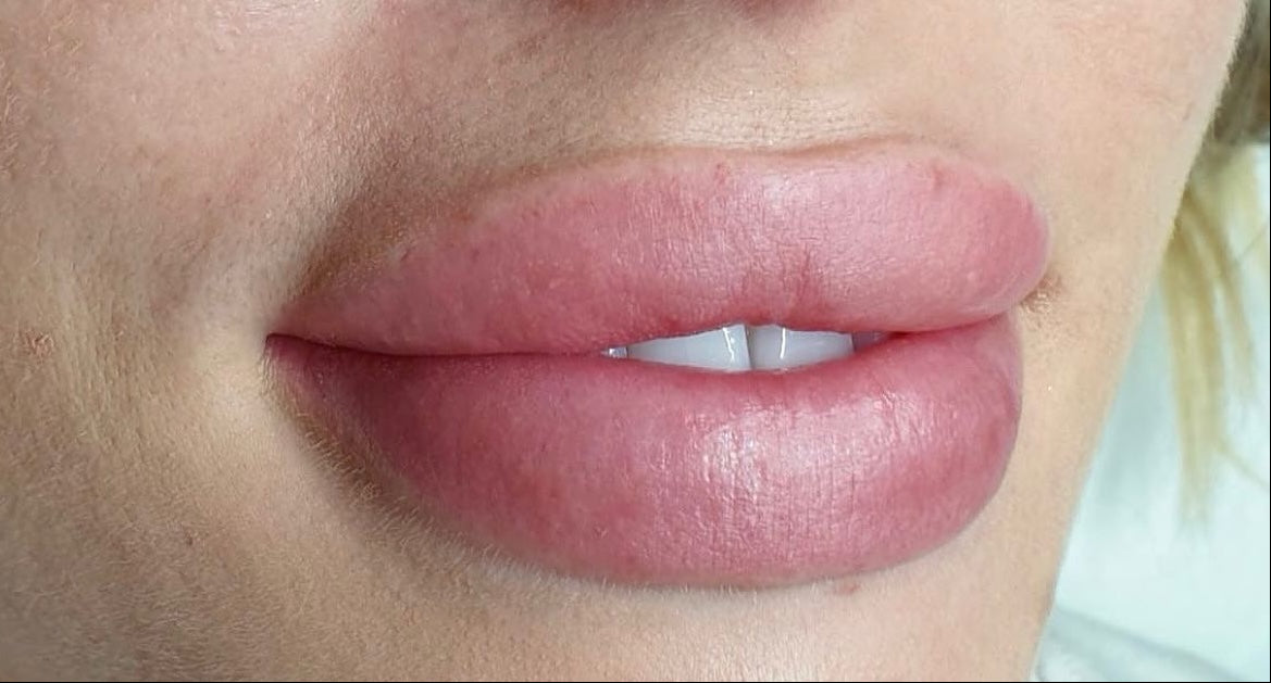 After lip blush Dubai showing enhanced colour, improved symmetry, defined borders, hydrated appearance, and healthy natural glow.