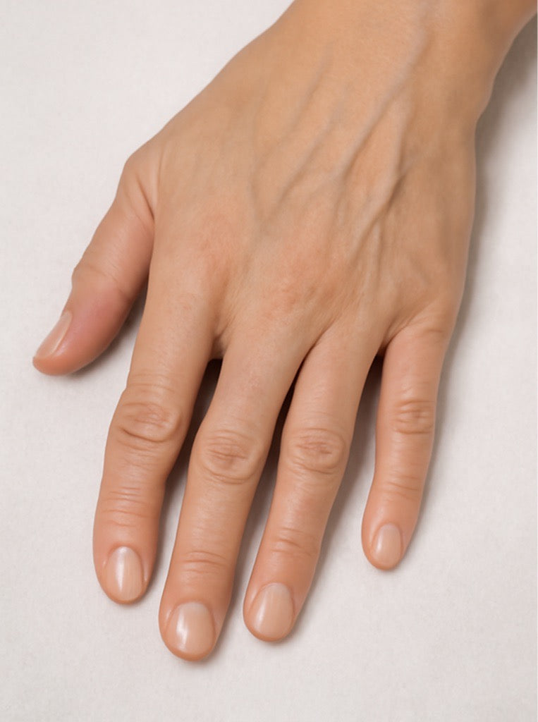 Hands showing visible volume loss, with prominent veins and tendons, as seen before Radiesse treatment.
