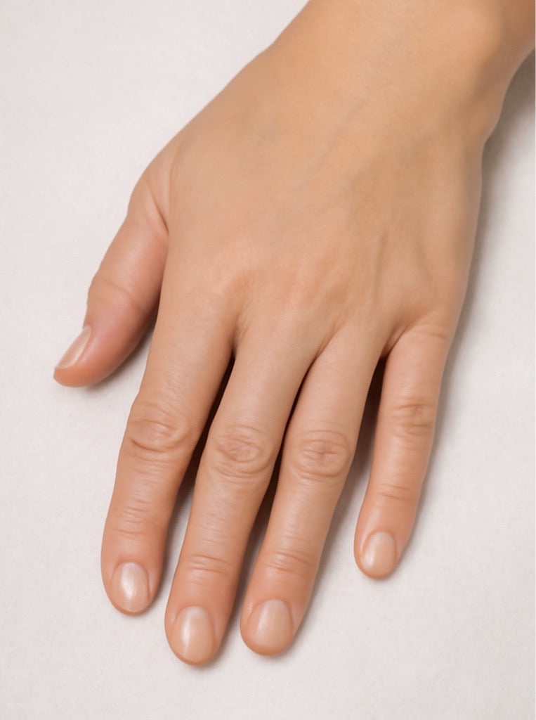 Hands after Radiesse treatment, with restored volume, smoother texture, and reduced visibility of veins and tendons.

