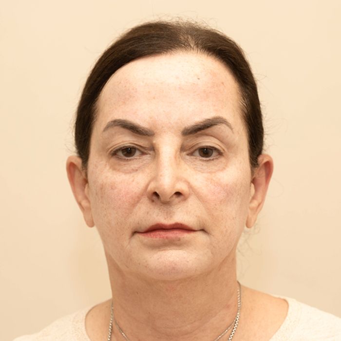 A woman’s face before Sofwave treatment, showing mild skin laxity, fine lines, or uneven skin texture