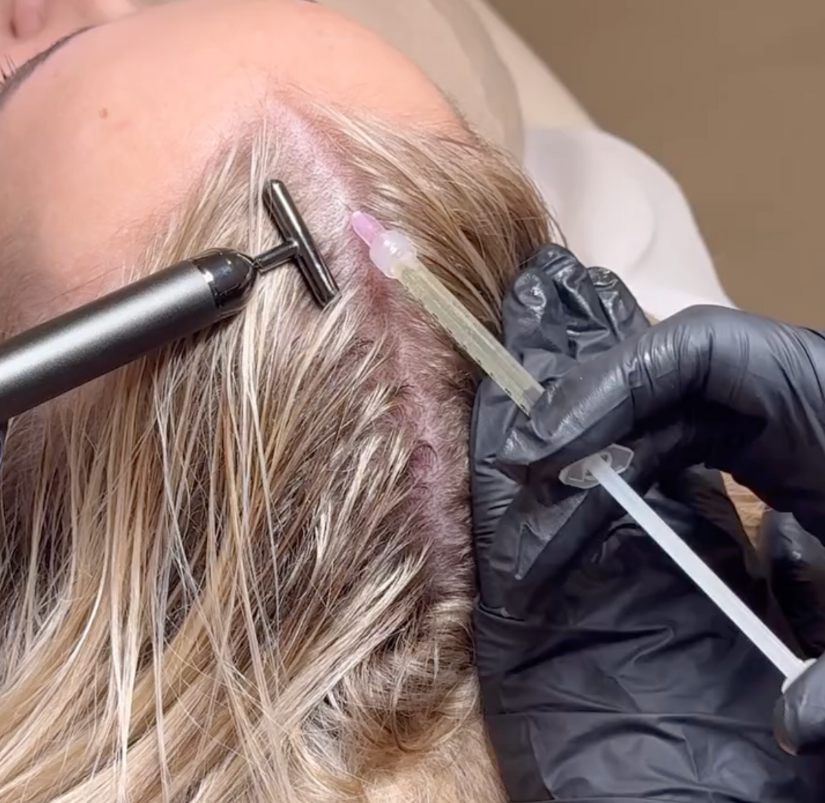 Woman trying PRP hair treatment at BROWZ in Dubai to support hair growth and stimulate collagen for stronger, healthier hair.