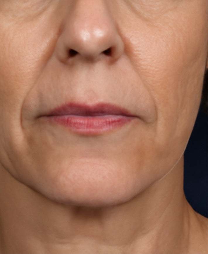 Close-up of a woman's lower face showing pronounced smile lines or nasolabial folds before Sculptra injections.
