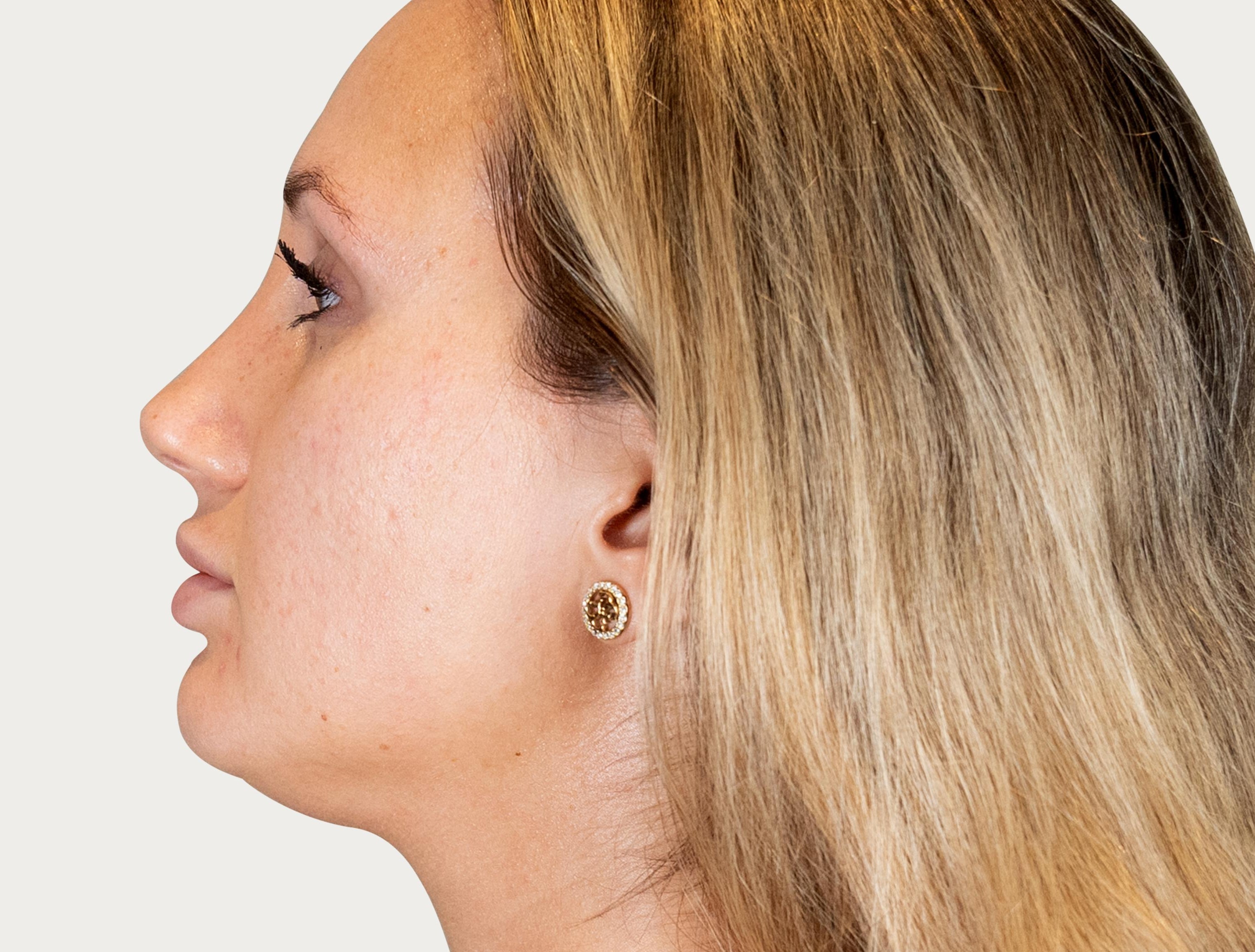Before facial harmonisation procedure