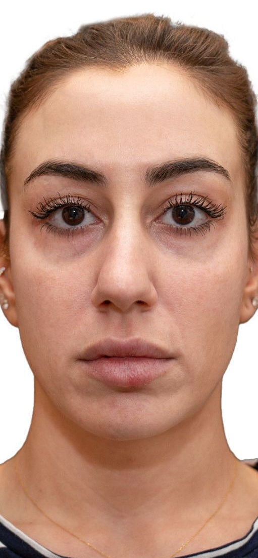Close-up of a woman's lower face showing pronounced smile lines or nasolabial folds before Sculptra treatment in Dubai at BROWZ.