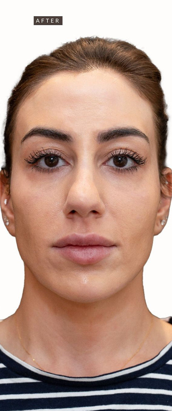 BROWZ Botox before and after photo showing smooth, youthful results following precise Botox injection treatment in Dubai.