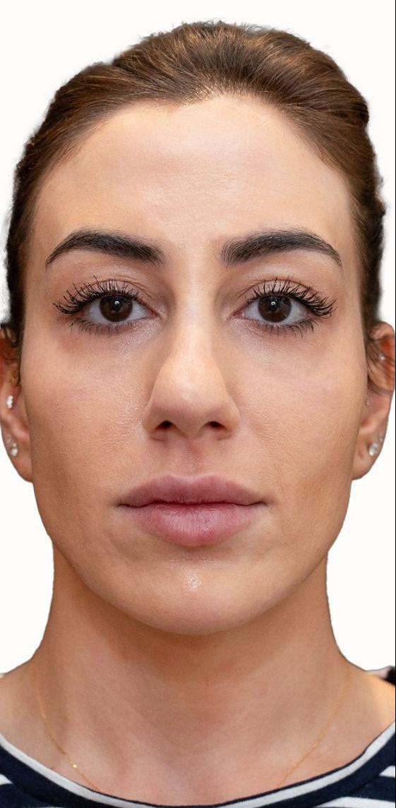 Close-up of a woman's face after Sculptra treatment in Dubai, with visibly smoother, fuller skin and reduced smile lines at BROWZ.