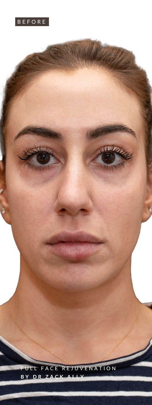 Botox before and after photo showing facial lines prior to Botox injection and treatment at BROWZ in Dubai for a refreshed look.