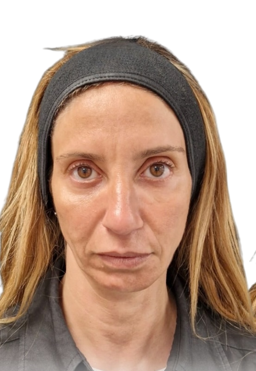 Botox before and after photo highlighting facial lines before Botox injection and personalised Botox treatment at BROWZ in Dubai.