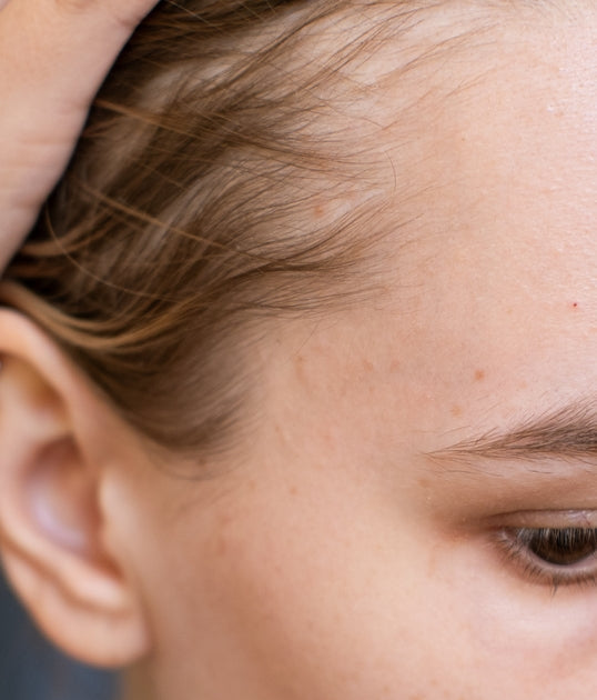 A woman’s thinning hair, illustrating how PRP therapy at BROWZ strengthens follicles and supports new hair growth over time.