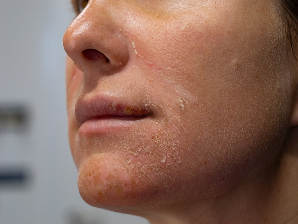 Close-up of a woman’s face showing sun-damaged skin, illustrating how PRP treatment helps restore and rejuvenate skin at BROWZ.