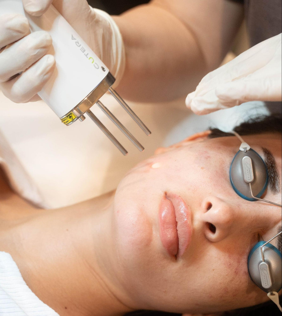Woman receiving Pico laser facial treatment at our clinic.