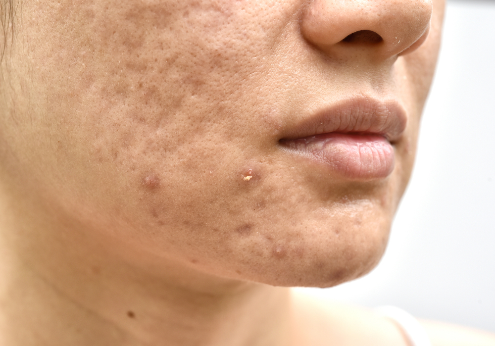 A woman’s skin showing acne scars and marks, illustrating how PRP treatment at BROWZ supports natural skin repair and regeneration