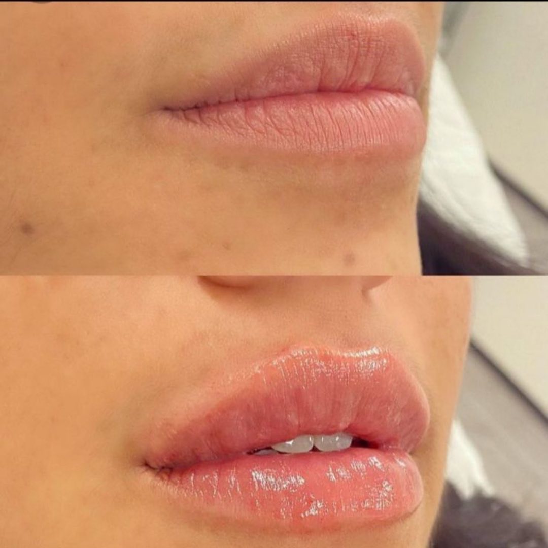 lip filler at BROWZ (before-after from google review) 5 star exeperience