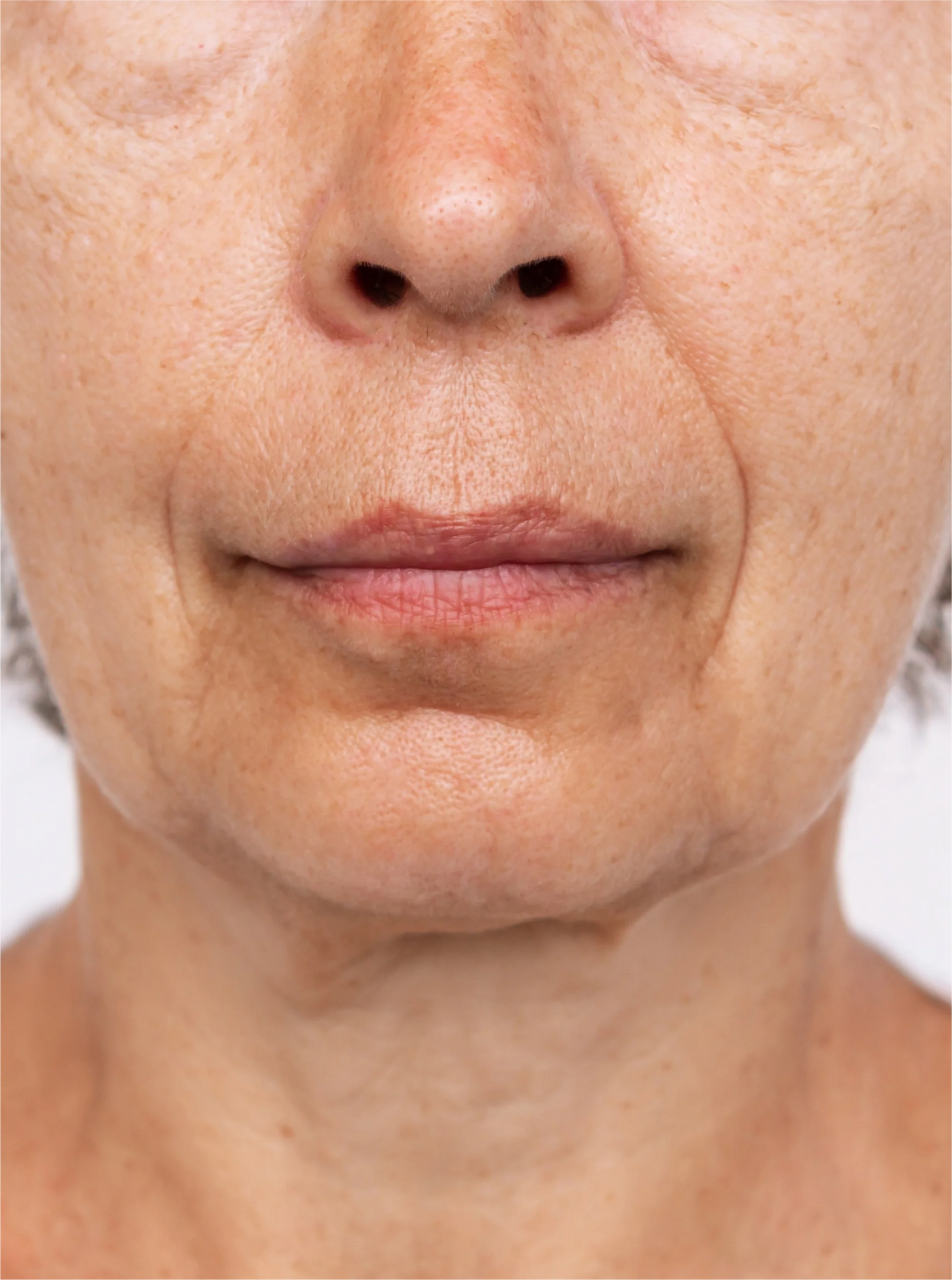 Naturally Hydrated and Lifted Skin | Before