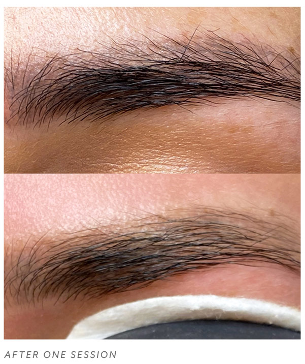 How Many Sessions To Remove Eyebrow Tattoo / How To Remove