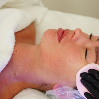 CO2 Facials for Dark Spots and Hyperpigmentation: How Effective Is It?