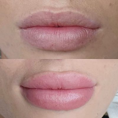 Frequently Asked Questions About Lip Blush